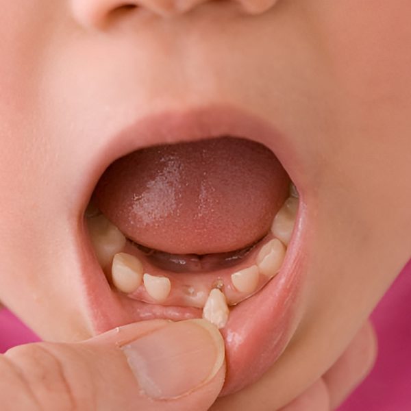 adult looking at a girl's loose tooth