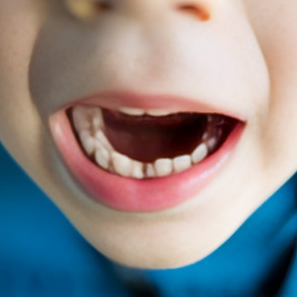 boy with a missing front tooth